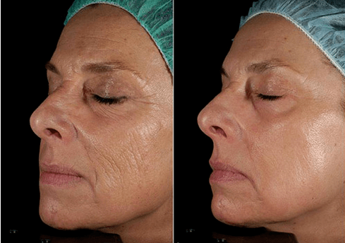 Rejuvenescimento a laser antes depois