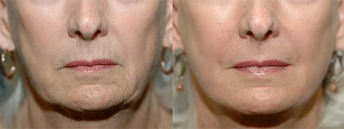 terapia a laser antes e depois