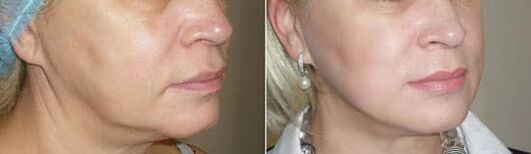 Foto depois de aplicar o procedimento