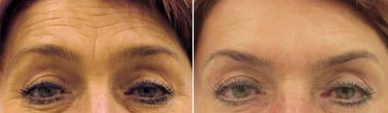 Rejuvenescimento de campo da testa