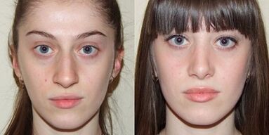 antes e depois do rejuvenescimento da pele com plasma