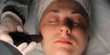 como se preparar para o procedimento de rejuvenescimento da pele com plasma