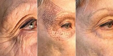 fotos antes e depois do rejuvenescimento da pele com plasma
